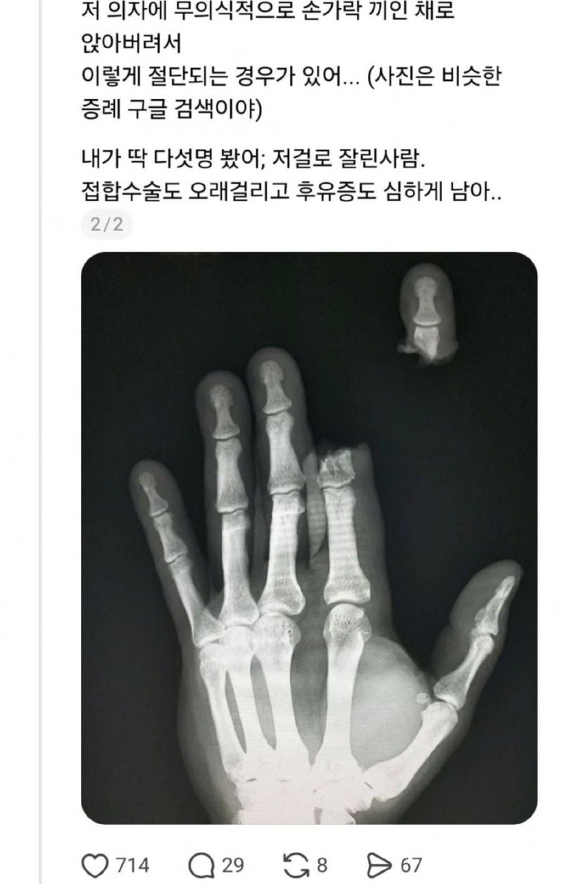 고깃집에서 손가락 절단 사고 주의보